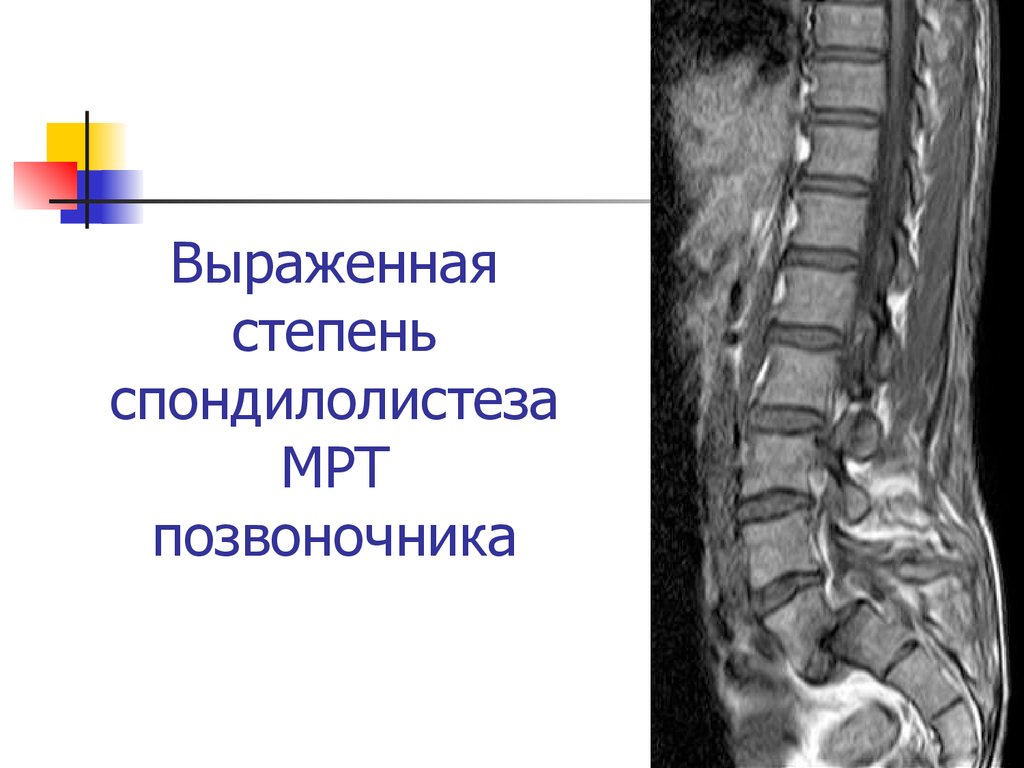 Отделы позвоночника для мрт схема фото и названия