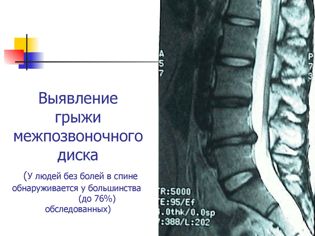 Грыжа межпозвонковых дисков презентация