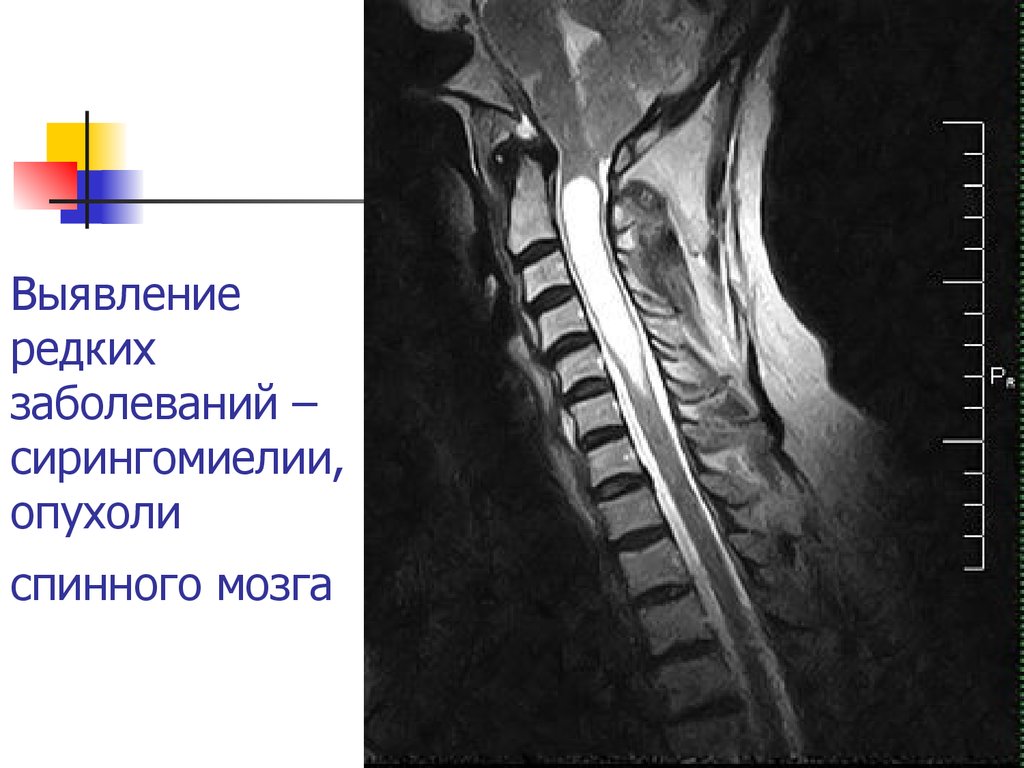 Гидромиелия шейного отдела