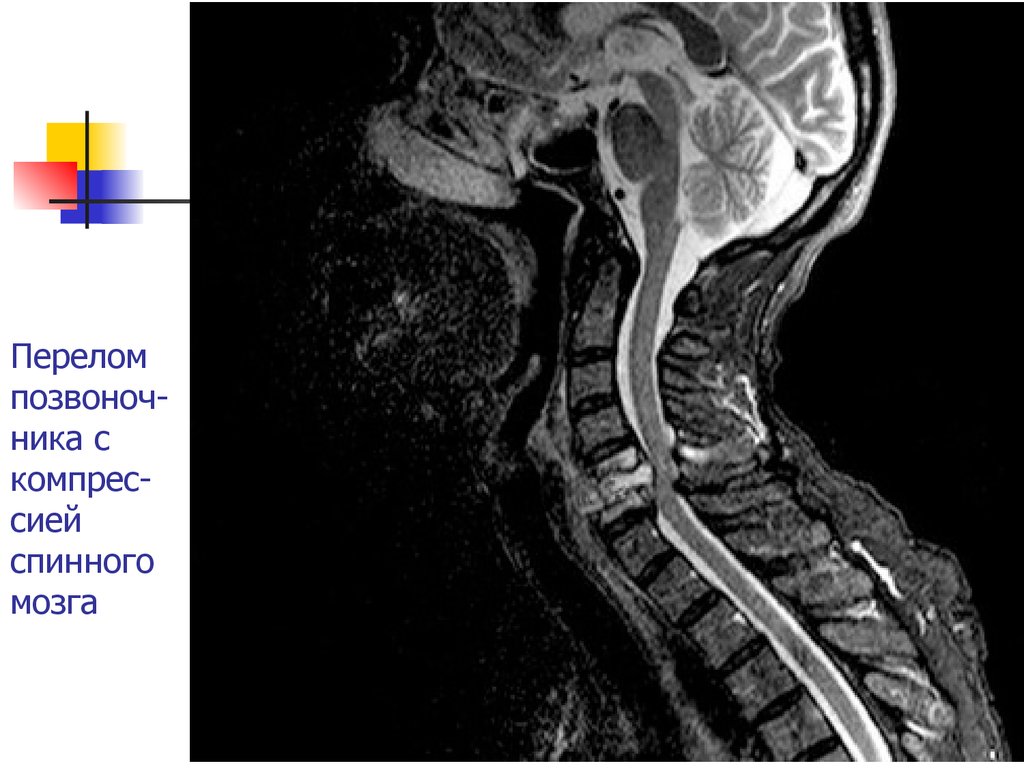 Шейный отдел мозг. Компрессионная миелопатия шейного отдела мрт. Миелопатия шейного отдела позвоночника мрт. Миелопатия спинного мозга мрт. Миелопатия грудного отдела на мрт.