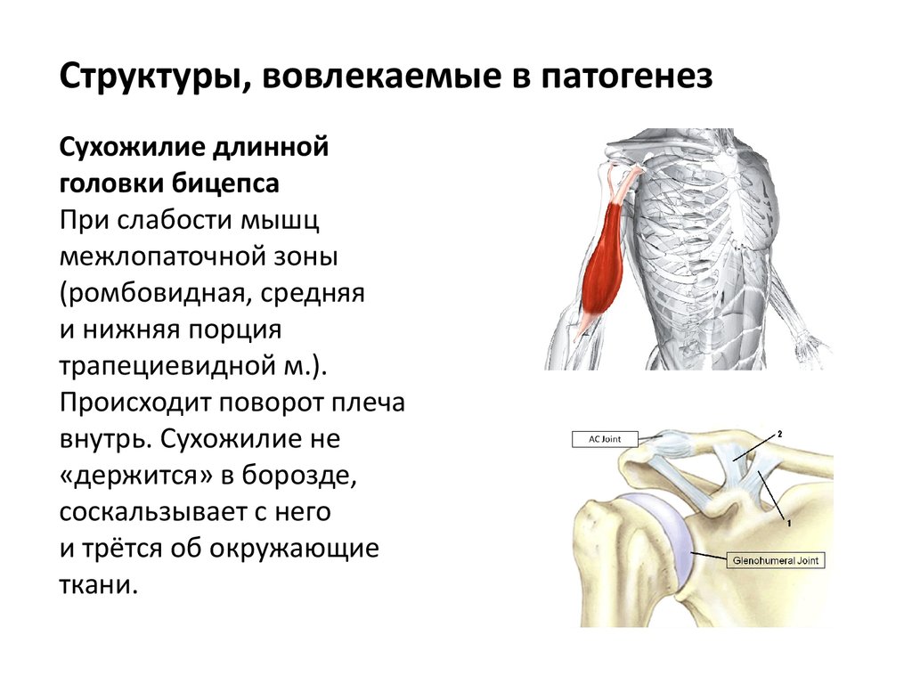 Плечевой периартрит что это. Сухожилие длинной головки бицепса. Плече-лопаточная периартрит. Длинная головка двуглавой мышцы плеча. Длинная и короткая головка бицепса.