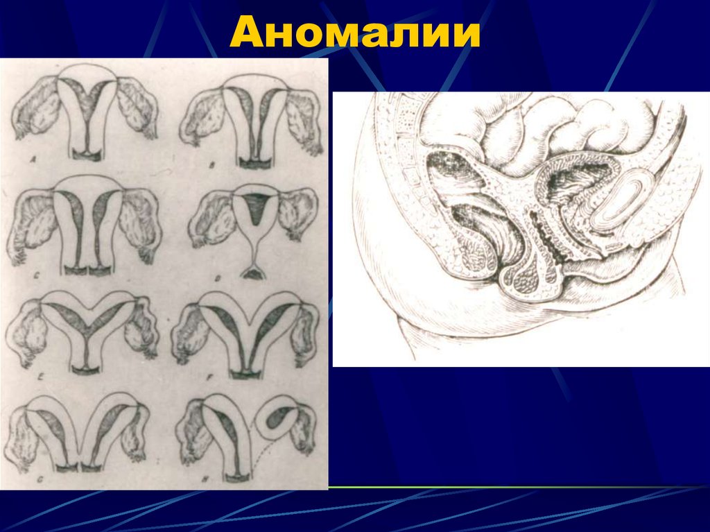 Аномалии мочеполовой системы презентация