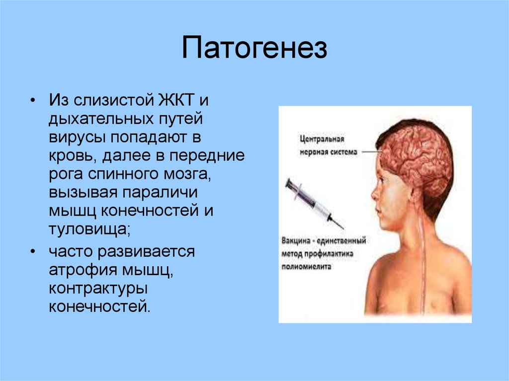 Центр полиомиелита. Полиомиелит пути передачи. полиомиелит этиология. паралич дыхательных мышц. актуальность полиомиелита.