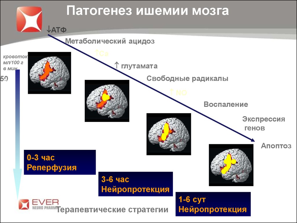 Хроническая ишемия мозга 1. Патогенез хронической ишемии головного мозга. Патогенез ишемического инсульта механизм. Ишемический инсульт головного мозга патогенез. Патогенез инсульта головного мозга.