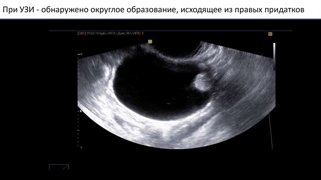 При УЗИ - обнаружено округ­лое образование, исходящее из правых придатков