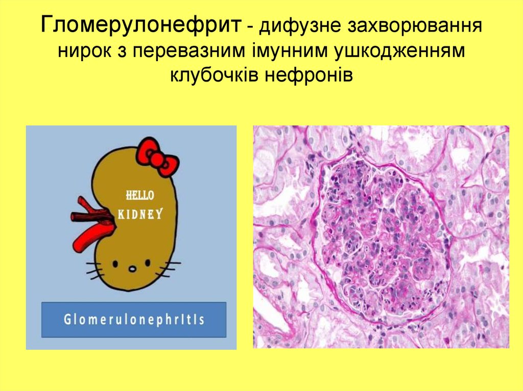 Презентация по гломерулонефриту