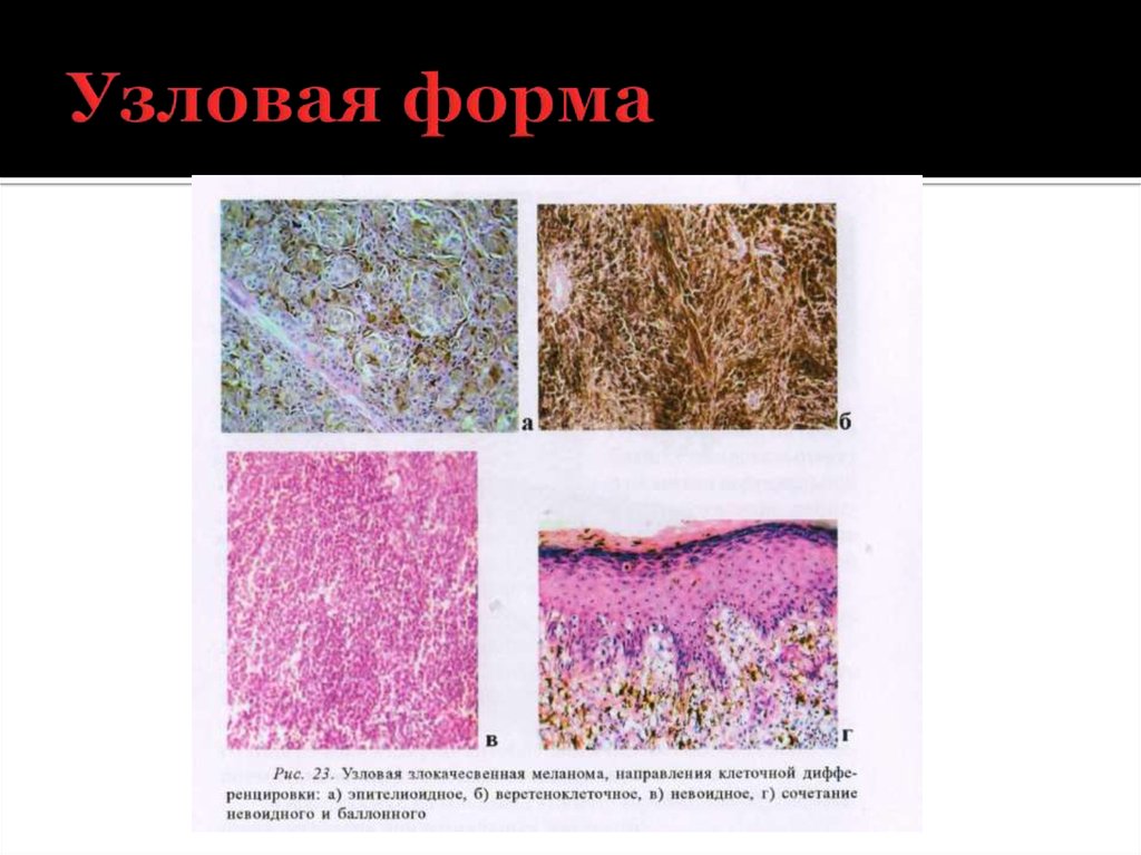 Меланома кожи микропрепарат. Нодулярная злокачественная меланома микроскопия. Эпителиоидная меланома. Узловая (нодулярная) меланома. Нодулярная меланома гистология.