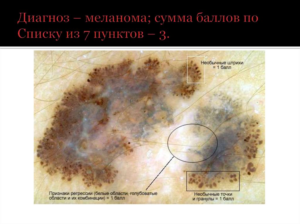 Меланома юнит москва отзывы. Лентигиозная меланома. Малигнизированная меланома.