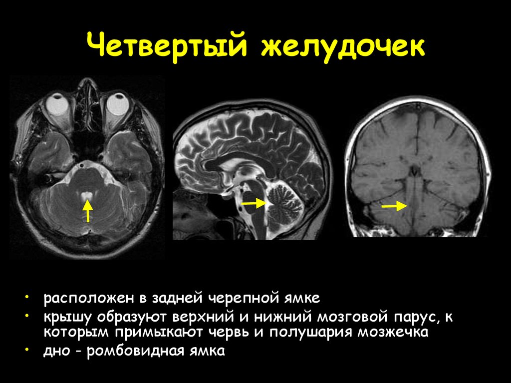 Образования желудочков мозга. Четвёртый желудочек головного мозга мрт. Четвёртый желудочек головного мозга анатомия. 4 Желудочек головного мозга анатомия кт. Мрт анатомия 4 желудочка.