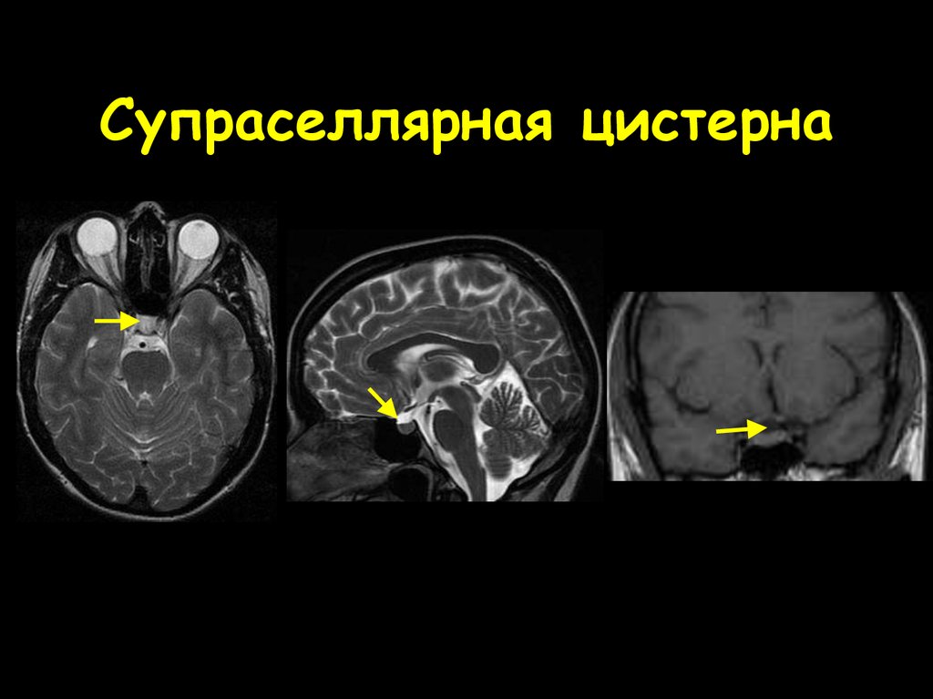 Супраселлярная цистерна пролабирует в полость