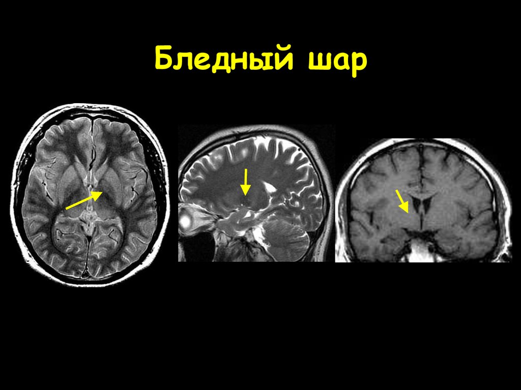 Изменение в базальных отделах. Анатомия головного мозга таламус кт. Хвостатое ядро мозга кт. Мрт головного мозга фронтальный срез. Базальные ядра кт анатомия.