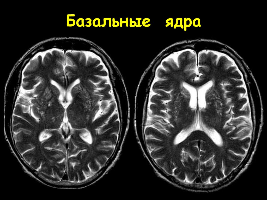 Изменение в базальных отделах. Базальные ядра головного мозга анатомия кт. Хвостатое ядро мрт анатомия. Базальные ганглии анатомия мрт. Базальные ганглии мозга на мрт.