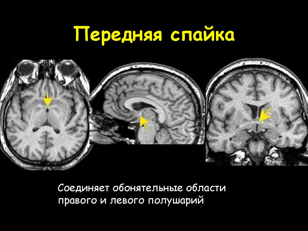 Спайка что означает. Передняя спайка головного мозга. Свод головного мозга анатомия. Передняя спайка конечного мозга. Передняя и задняя спайки мозга головного.