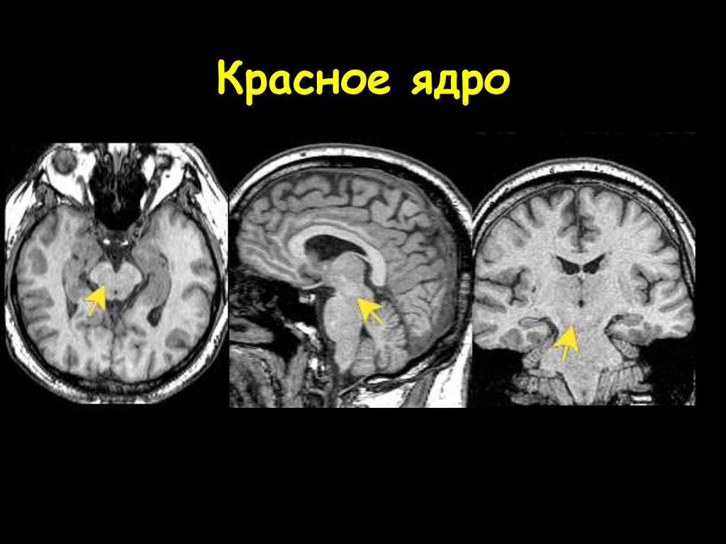 Красное ядро. Черная субстанция и красное ядро на мрт. Красное ядро среднего мозга. Черная субстанция на мрт. Красного ядра головного мозга мрт.