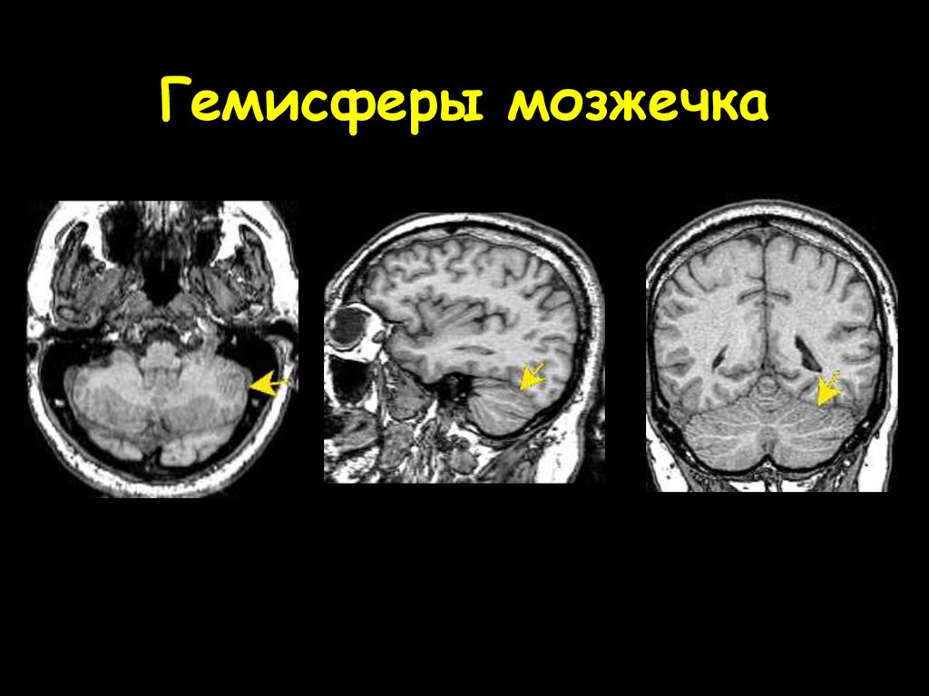 Левая гемисфера головного мозга. Кт новообразование мозжечка. Мальформация мозжечка мрт. Венозная ангиома мозжечка мрт. Гипоплазия гемисферы мозжечка.