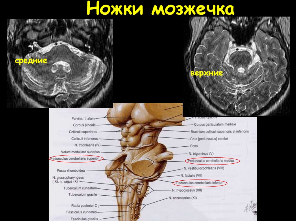 Средние ножки мозжечка. Ножки мозжечка анатомия мрт. Ножки мозжечка кт мрт анатомия. Средняя ножка мозжечка анатомия. Верхняя мозжечковая ножка.