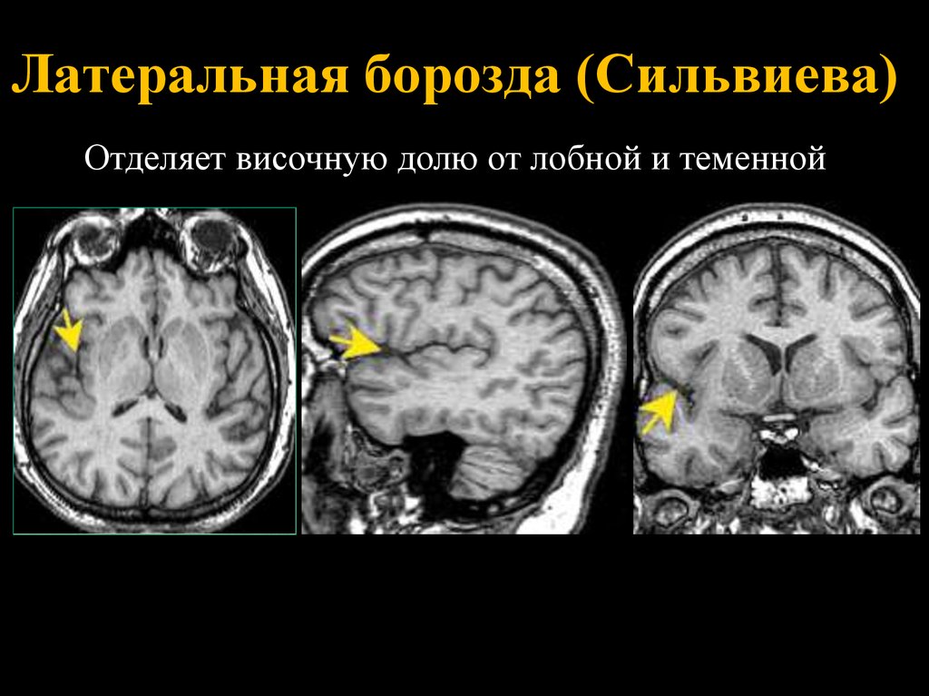 Цистерны мозга расширены. Сильвиева щель мрт. Анатомия плода сильвиева борозда. Сильвиева щель в головном мозге. Сильвиева щель анатомия.
