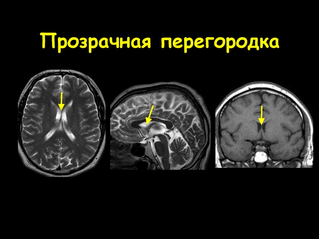 Прозрачная киста