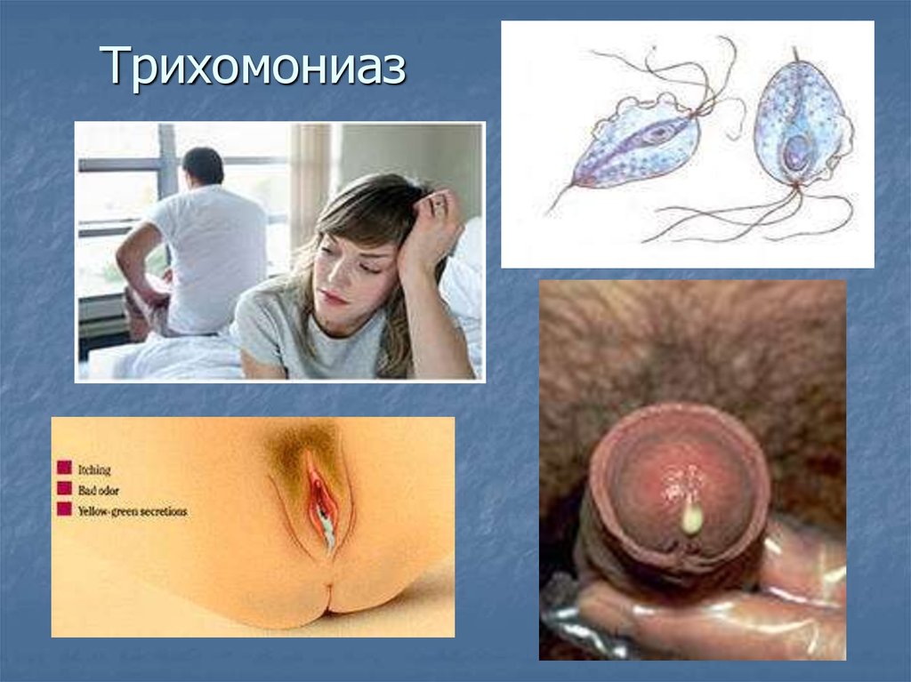 Pdf Nitroimidazole Resistance In Trichomonas Vaginalis Infection