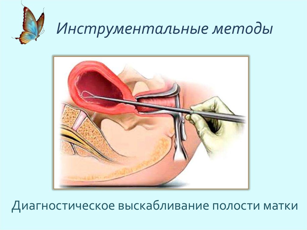 Выскабливание полости матки. Диагностическое выскабливание слизистой оболочки тела матки. Инструментальный кюретаж полости матки. Диагностическое выскабливание полости матки алгоритм. Раздельное диагностическое выскабливание слизистой оболочки матки.