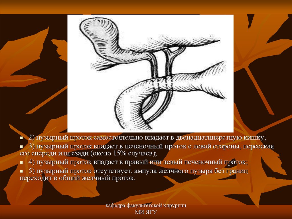 Хронический холецистит операция