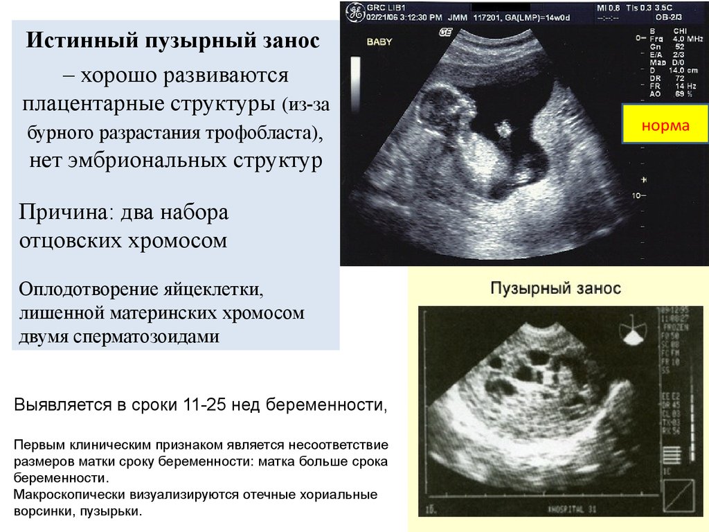 Пузырный занос. Пузырный занос УЗИ признаки. УЗИ при пузырном заносе. ХГЧ при пузырном заносе.