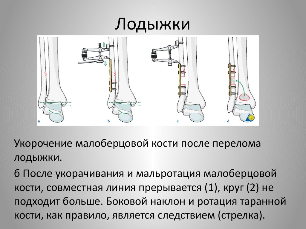 Укорочение трубчатых костей. Корригирующие операции при деформации суставов. Укорочение малоберцовой кости. Укорочение конечности при переломе. Мальротация кости.