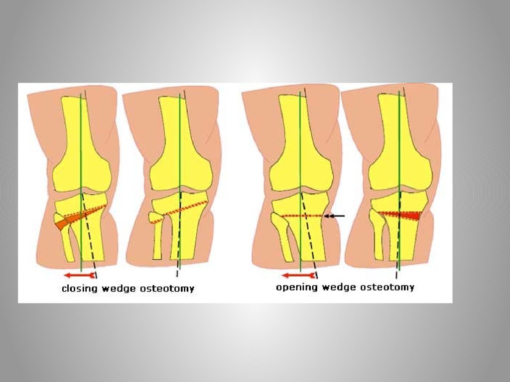 Остеотомия. Корригирующая околосуставная остеотомия. Операция остеотомия коленного сустава. Корригирующая остеотомия при деформации коленного сустава. Остеотомия при варусной деформации.