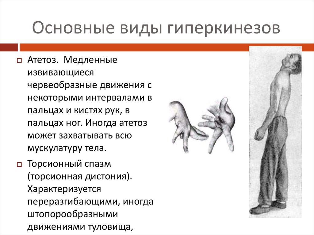 Центральный и периферический паралич презентация