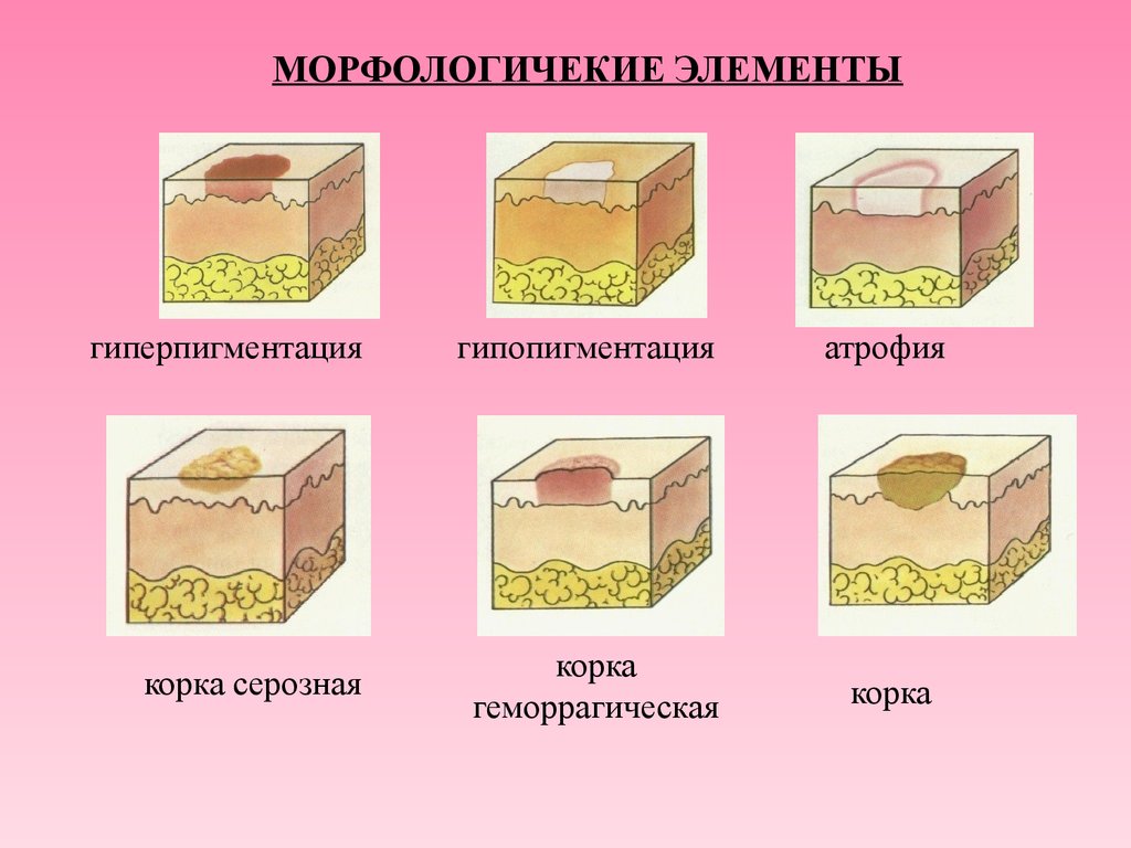 Элементы сыпи. Вторичные морфологические элементы кожи гиперпигментация. Вторичные морфологические элементы кожи корка. Первичные морфологические элементы кожи экскориация. Элементы кожной сыпи Дерматовенерология.