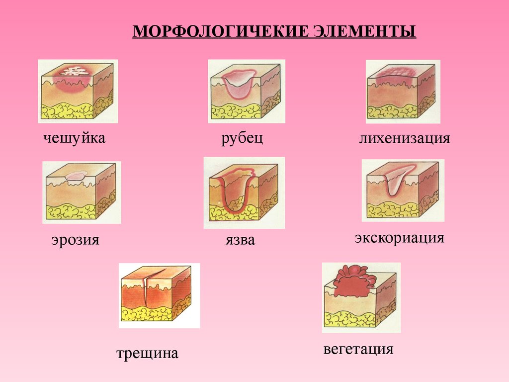 Элементы кожи. Вторичные морфологические элементы кожной сыпи. Первичные и вторичные морфологические элементы кожной сыпи. Первичные и вторичные морфологические элементы кожных высыпаний. Вторичные морфологические элементы кожи Дерматовенерология.