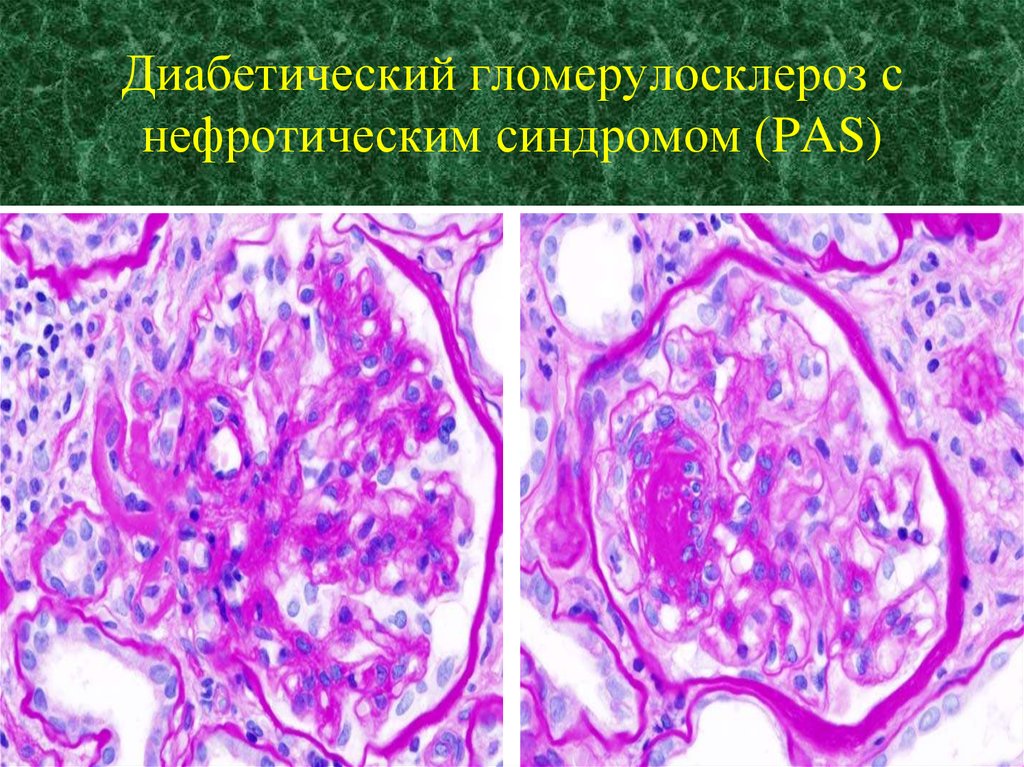 Сахарный диабет патанатомия презентация