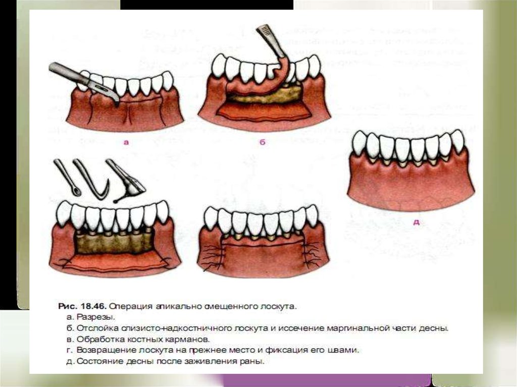 Лоскут зубы. Лоскутная операция (по Видман- Нейману- Цешинскому) методика. Апикально смещенный лоскут. Коронарное смещение лоскута.