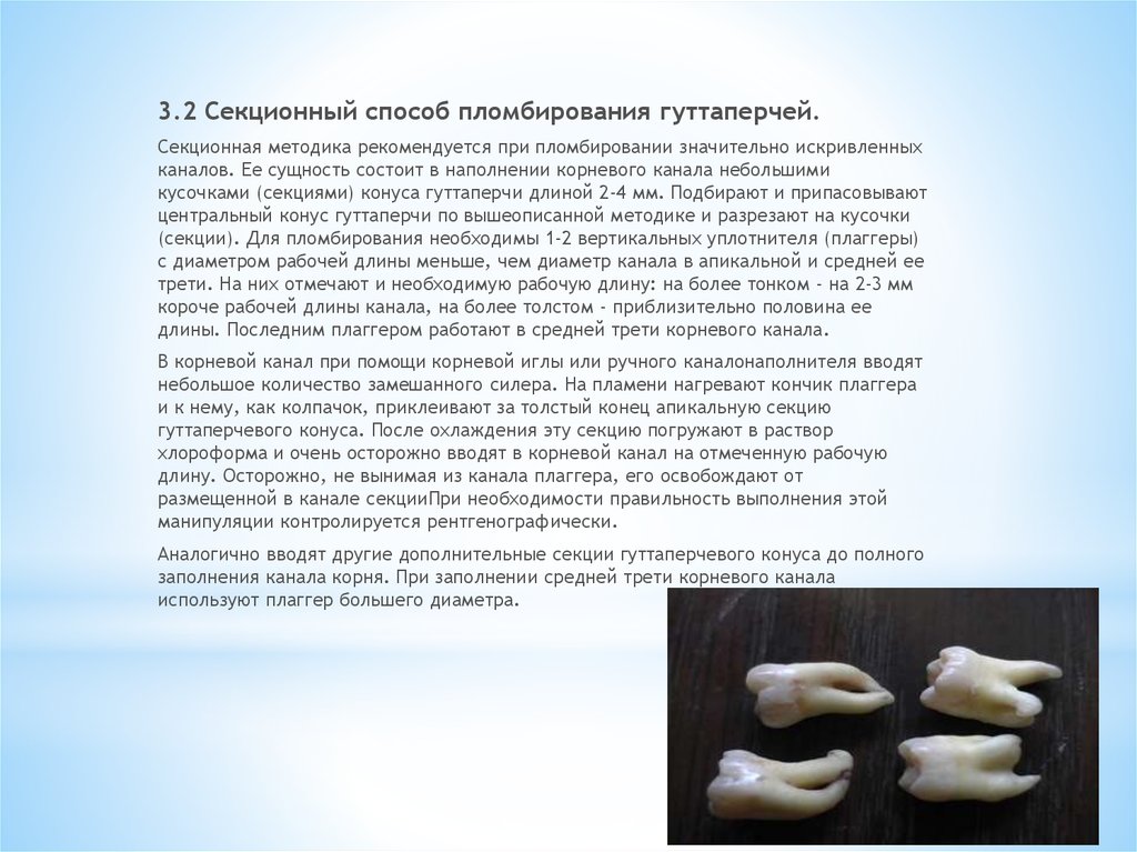 Пломбирование корневых каналов презентация