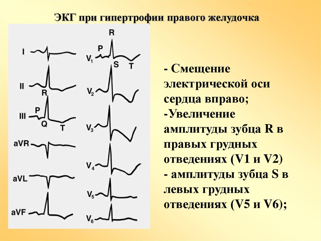 Глж на экг что это значит. Гипертрофия правого желудочка на ЭКГ. Электрическая ось сердца (ЭОС) на ЭКГ. ЭКГ признаки гипертрофии левого желудочка на ЭКГ. ЭОС вправо на ЭКГ.