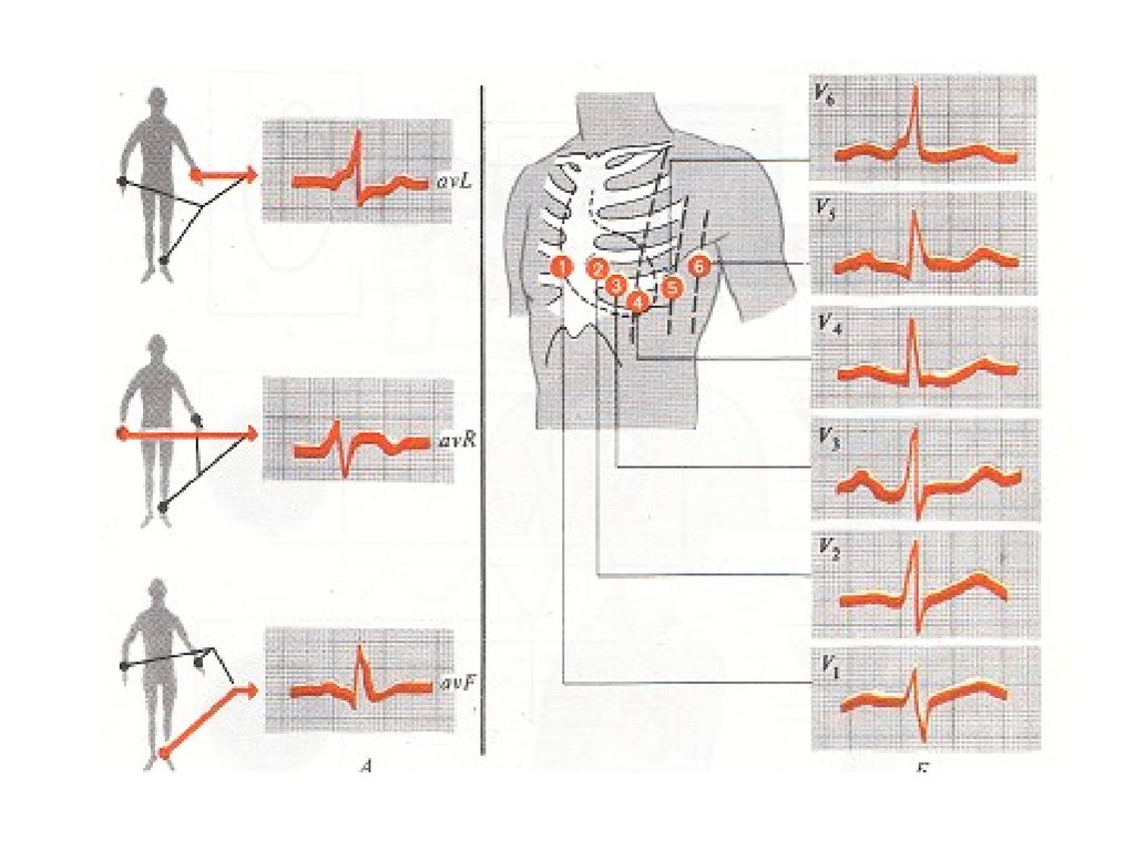 Наложение экг. Схема наложения электродов ЭКГ при декстрокардии. Наложение электродов при декстрокардии. Схема наложения электродов при декстрокардии. Декстрокардия наложение электродов ЭКГ грудные.