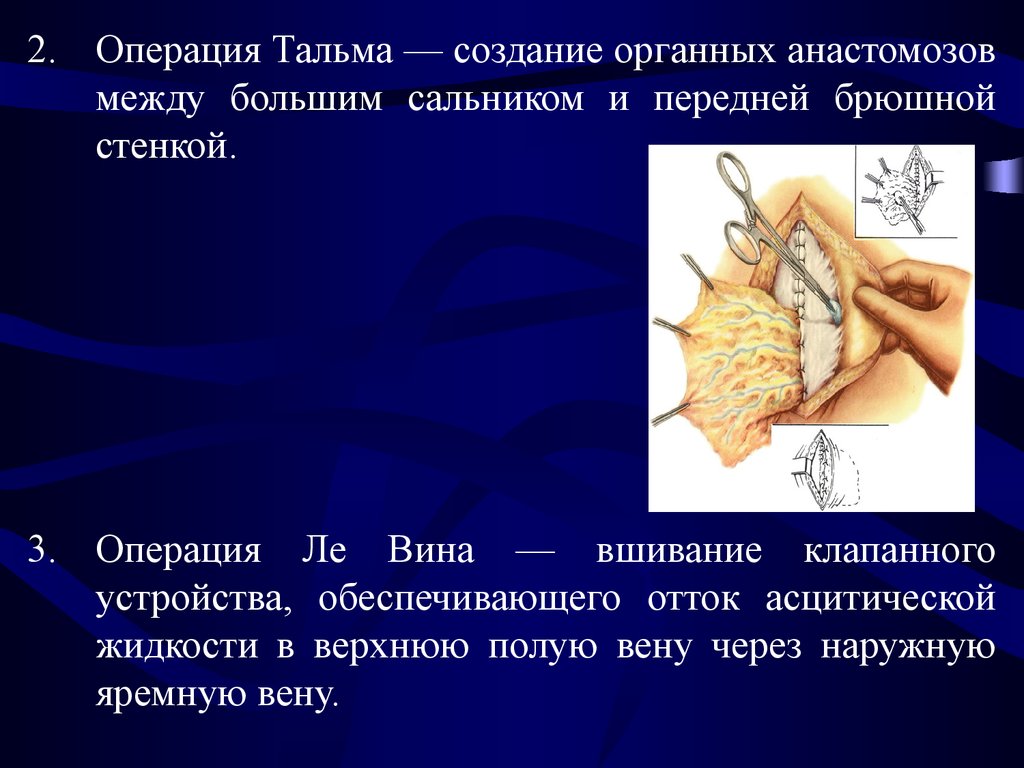 Кровотечение при портальной гипертензии