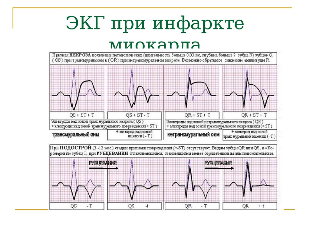 Изменение зубца q. ЭКГ инфаркт миокарда ЭКГ. Снимок ЭКГ при инфаркте миокарда. Острый инфаркт миокарда ЭКГ расшифровка. Нормальная ЭКГ И при инфаркте миокарда.