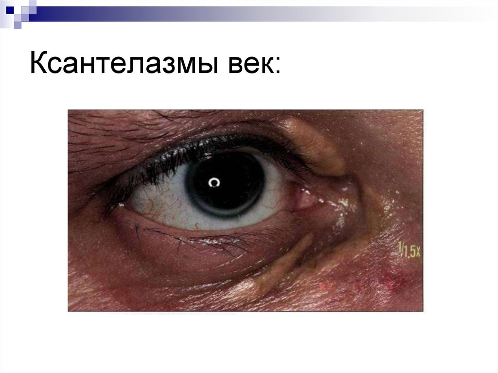 Ксантелазмы век: