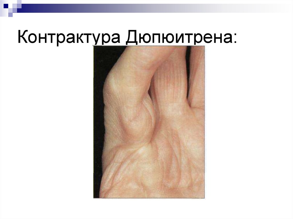 Контрактура Дюпюитрена: