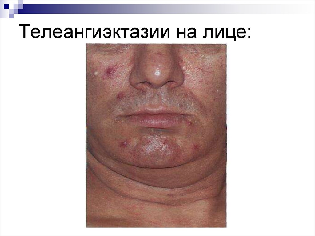 Телеангиэктазии на лице: