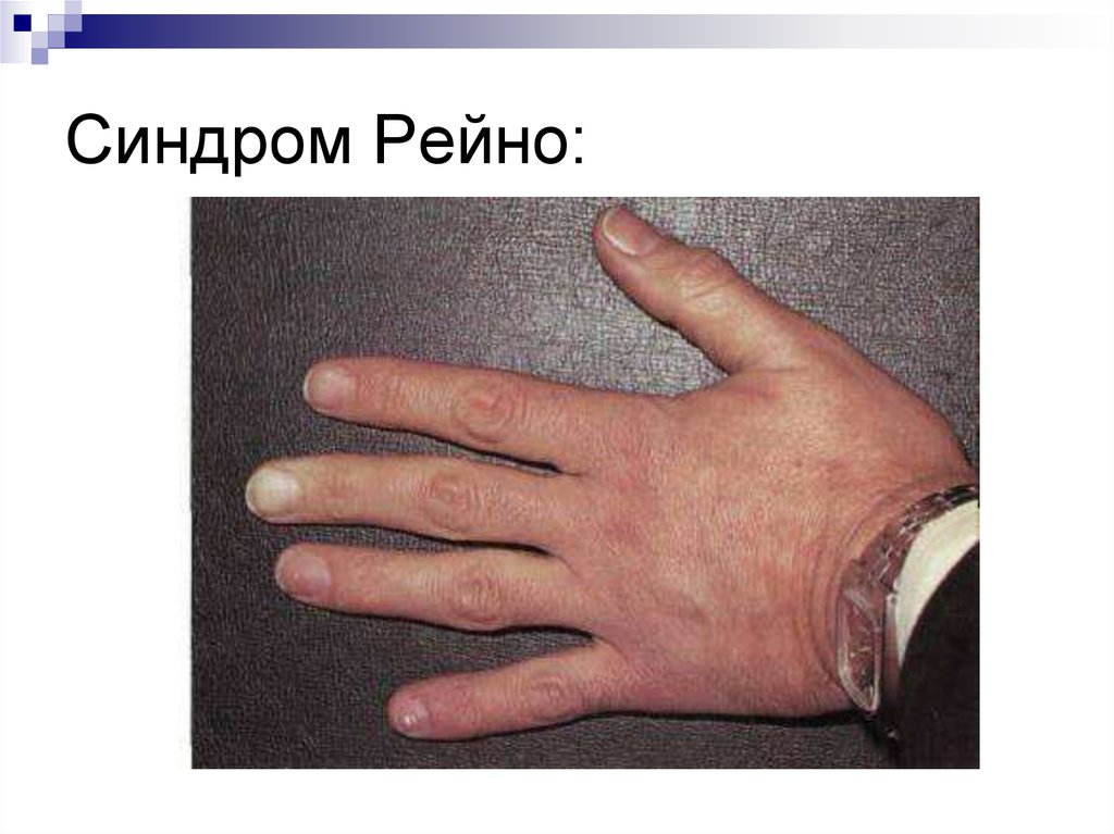 Синдром Рейно:
