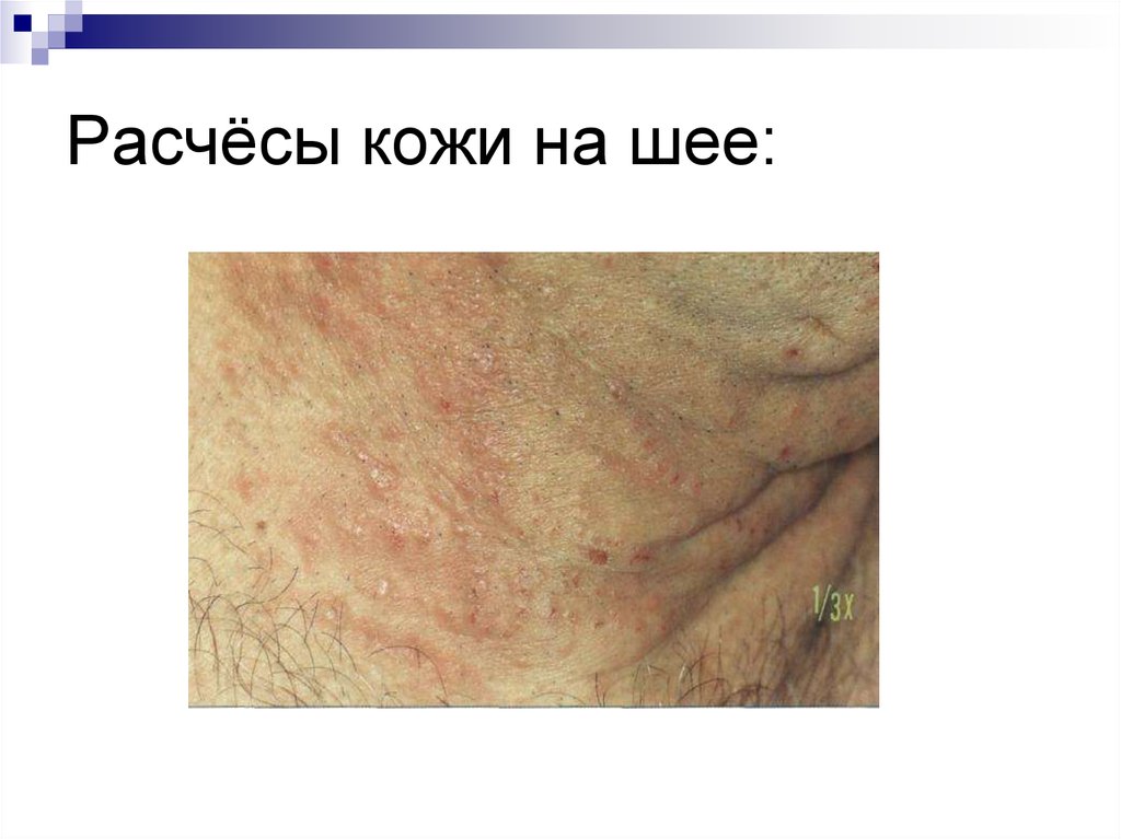 Расчёсы кожи на шее:
