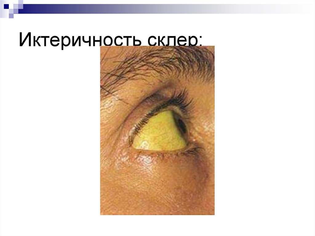 Иктеричность склер: