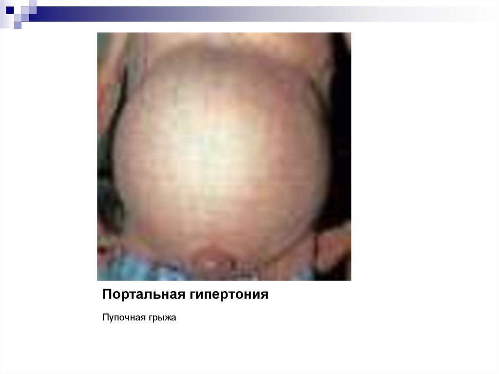 Портальная гипертония