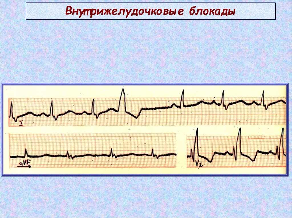 Нарушение внутрижелудочковой проводимости на экг. Внутрижелудочковые блокады на ЭКГ. Местная внутрижелудочковая блокада на ЭКГ. Очаговая внутрижелудочковая блокада. ЭКГ при нарушении внутрижелудочковой проводимости.