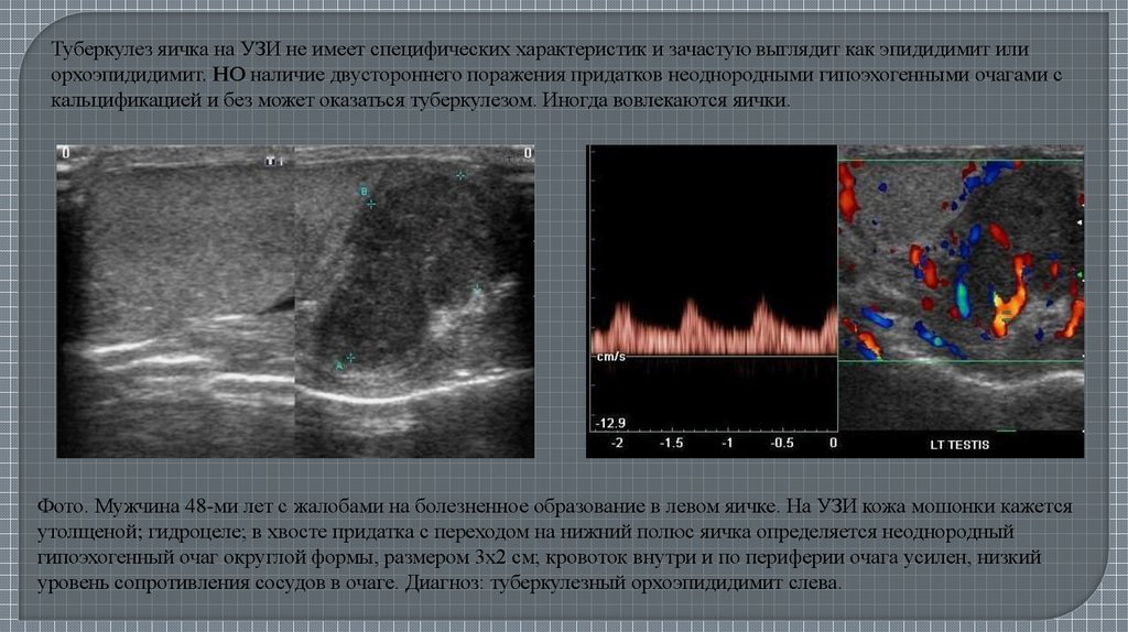 Туберкулез мужских органов презентация