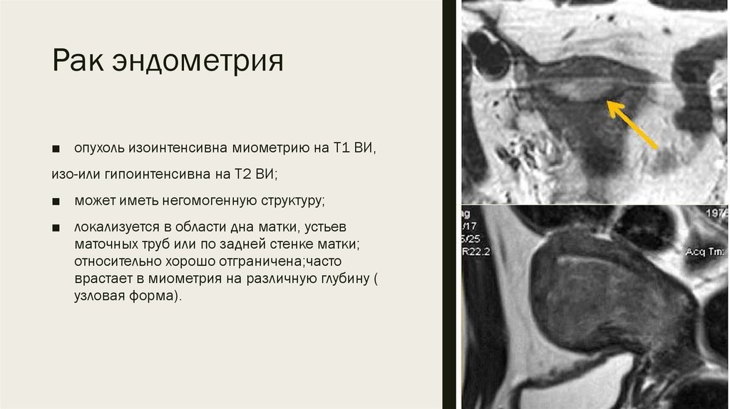 Новообразования эндометрия. Опухоль эндометрия мрт. Карцинома эндометрия мрт. Гиперплазия эндометрия матки мрт. УЗИ признаки опухоль эндометрия.