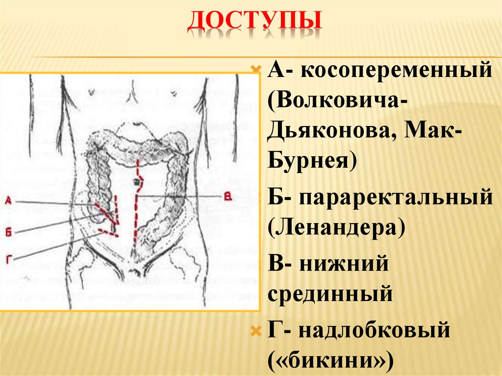 При типичной картине острого аппендицита операционным доступом является