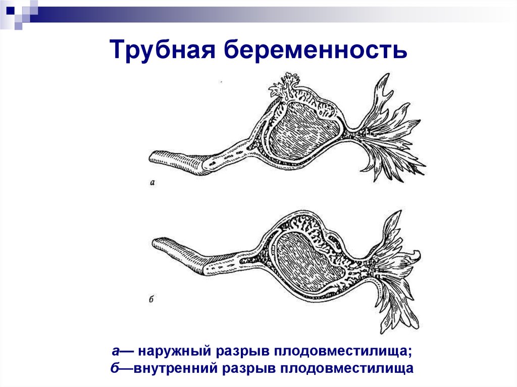 Трубная беременность микропрепарат рисунок